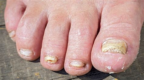 Why Do Big Toenails Turn Yellow Share News About Nail
