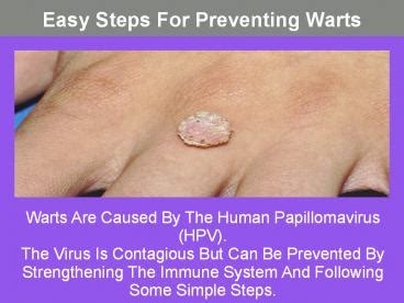 PPT Easy Steps For Preventing Warts PowerPoint Presentation Free To