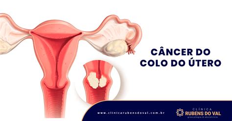 Many cancer cells form by a prior cancer cell dividing and creating two cancer cells. Câncer do Colo do Útero: prevenção - Clínica Rubens do Val ...