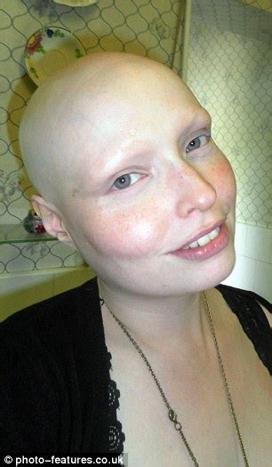 Brenda Finn Left Completely Bald By Alopecia On Bully Hell Before £300 Treatment Daily Mail Online