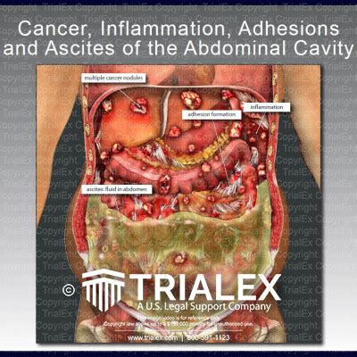 Cancer Inflammation Adhesions And Ascites Of The Abdominal Cavity