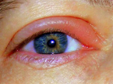 Treating An Eye Stye At Home Remedygrove