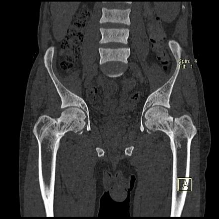 Renal Osteodystrophy And Insufficiency Fractures Image Radiopaedia Org