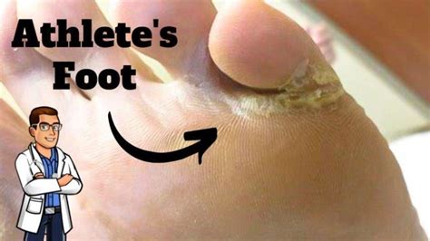 Dry Feet Or Athletes Foot Dry Feet Home Remedies And Treatment