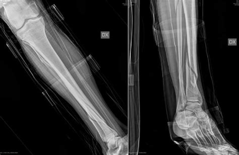 Ab Ao 42 A1 Fracture Of Right Tibia Download Scientific Diagram