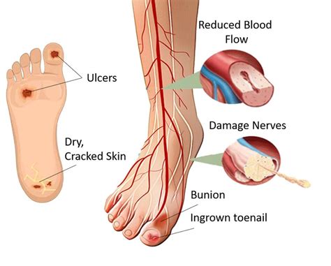 7 Reasons Why Your Diabetic Foot Ulcer Healing Is Slow