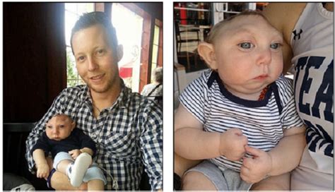 Baby Jaxon Born With Anencephaly Defies The Odds Turns Year Old LifeNews Com