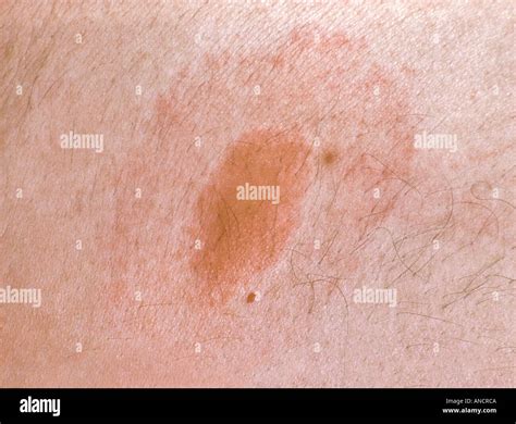 Target Rash From Deer Tick Bite Transmitting Lyme S Disease Stock Photo
