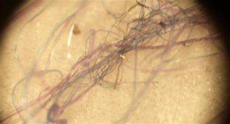 Inside Morgellons The Internets Disease Gizmodo Australia