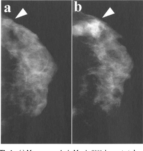 Figure 1 From A Case Of Phyllodes Tumor Of The Breast With A Lesion