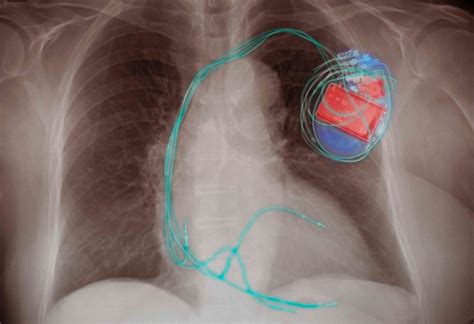 Implantable Cardioverter Defibrillator Complications