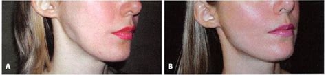 Masseter Muscle Reattachment After Mandibular Angle Surgery World