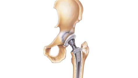 Biomet Hip Replacements M2a And Other Hip Implants