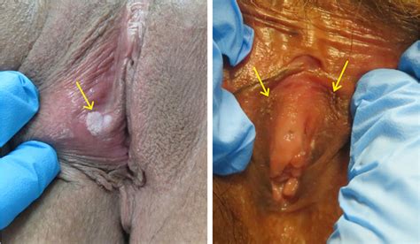 Figure 1 From Benign Lumps And Bumps Of The Vulva A Review