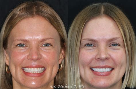 Smile Makeover Of The Month A Complete Veneer Transformation Michael