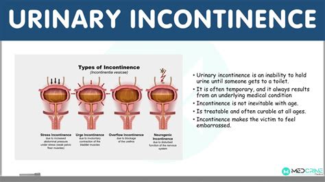 Urinary Incontinence Definition Types Causes Diagnosis And Treatment Youtube