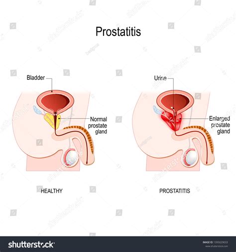 Prostatitis Swelling Inflammation Prostate Gland That Stock Illustration