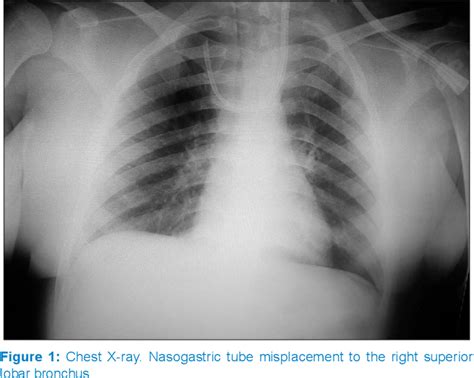 Figure 1 From The Importance Of Chest X Ray During Nasogastric Tube