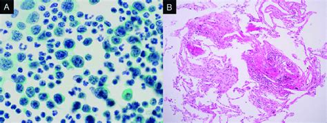 Cytologic Examination Of Pericardial And Pleural Effusion Revealed