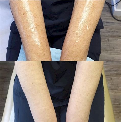 Intense Pulsed Light Ipl For Acne Scars Schweiger Dermatology