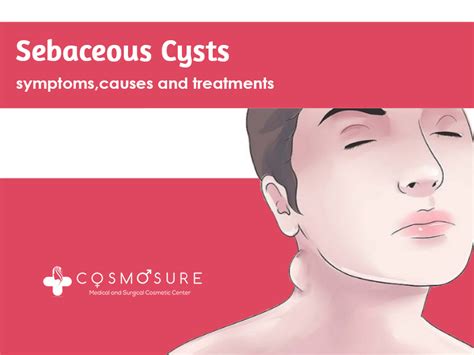 Cosmosure Clinic — Sebaceous Cysts Symptoms Causes And Treatments