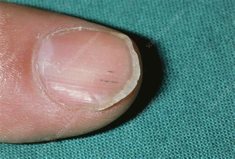 Splinter Haemorrhage On Fingernail In Endocarditis Stock Image M172