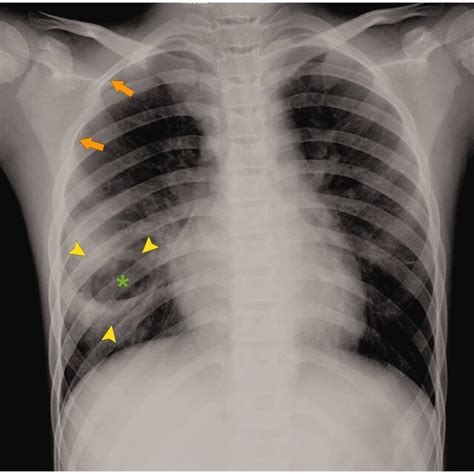 Chest Ct Images Showing Thick Walled Multicystic Lesions Asterisks
