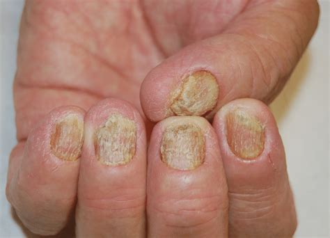 Nail Matrix Psoriasis Of Fingernails Download Scientific Diagram