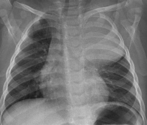 Chest X Ray Demonstrating A Mass Occupying The Left Upper And Mid