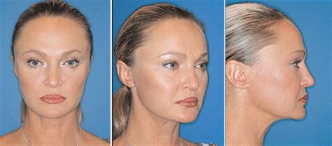 Advanced Cheek Implant Chin Implant Facial Implants Facial Implant
