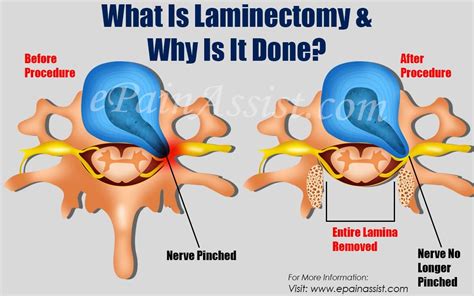 Laminectomy Syndrome