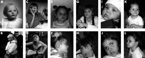 Clinical Photographs Of Patients Ad Patient 1 Age 4 Months 5