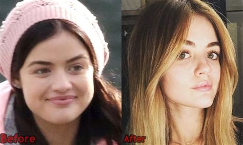 Lucy Hale Plastic Surgery Before And After Photos