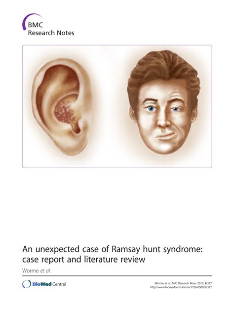 Hunter Ramsey Syndrome Ppt Ramsay Hunt Syndrome Causes Symptoms