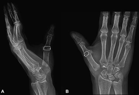 Revision Of The Failed Thumb Carpometacarpal Arthroplasty Journal Of