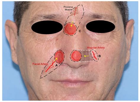 Jcm Free Full Text Locoregional Flaps For The Reconstruction Of