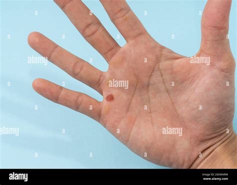Hand Palm With A Blister Stock Photo Alamy