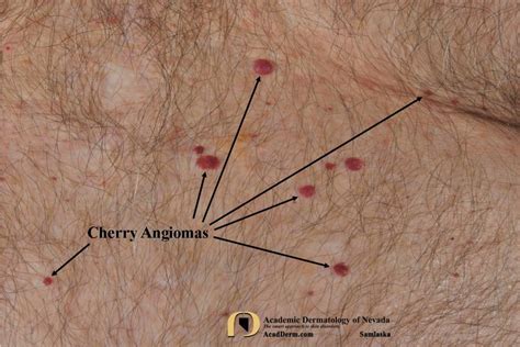 Cherry Angioma Senile Angioma Academic Dermatology Of Nevada