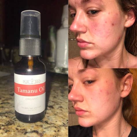 Best Serum For Pitted Acne Scars