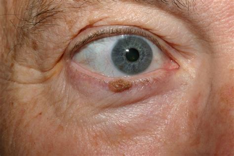 Actinic Keratosis Eyelid