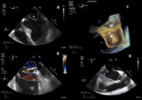 A Tee Four Chamber View Showing A Large Aneurysm Of The Mitral