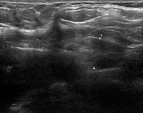 Ultrasound Neck Image Illustrating The Parathyroid Adenoma Measuring 11
