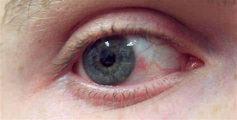 Blue Eye With Mild Nodular Episcleritis By Kmjarrett Videohive