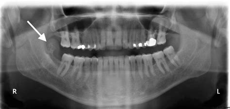 Peripheral Osteoma Of The Mandibular Crest A Short Case Study