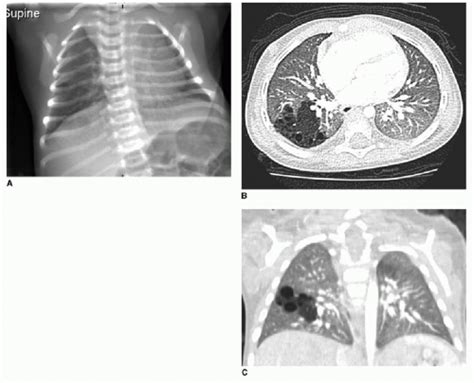 Congenital pulmonary airway malformation (cpam), is the most common malformation of the lower respiratory tract. Congenital Lung Lesions | Radiology Key