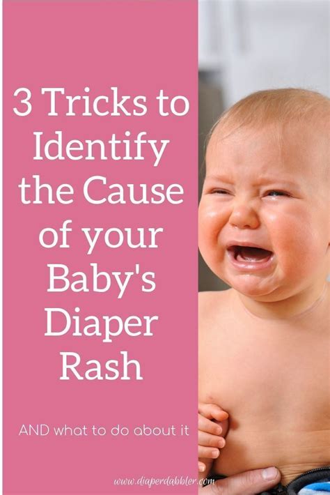 3 Tricks To Identify The Cause Of Your Babys Diaper Rash Baby Diaper