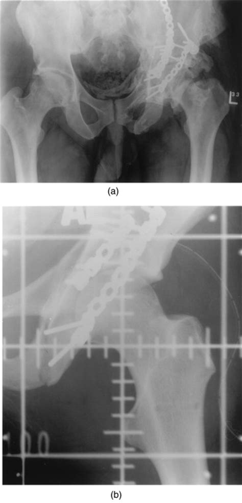 Utility Of Radiation In The Prevention Of Heterotopic Ossification