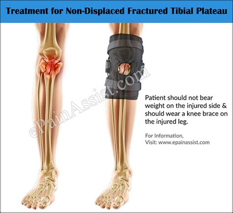 Diagnosis And Treatment For Fractured Tibial Plateau Or Tibial Plateau