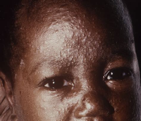 Measles Nearly 4 Million Nigerian Children Missed Vaccine The Icir