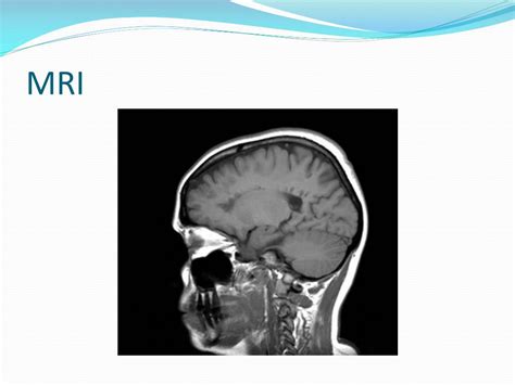 Citikolin v neuroprotekci a neuroregeneraci: PPT - Co je to roztroušená skleróza mozkomíšní PowerPoint ...